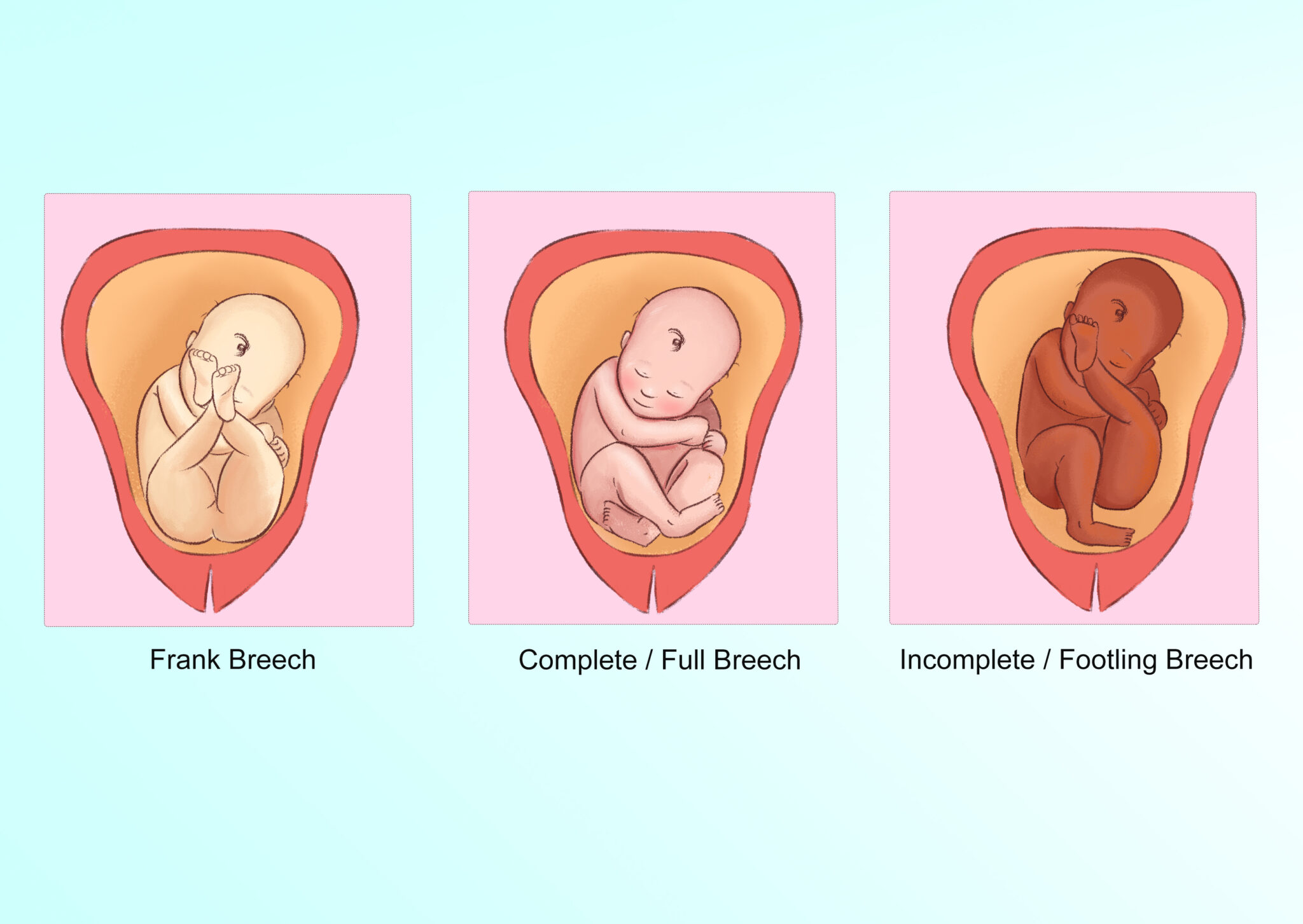 Turning A Breeched Baby - Fit For Birth